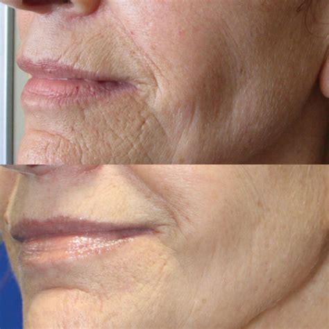 Radiofrequency Microneedling Before and After Photos - House of Beauty