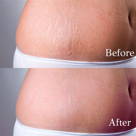 Advance Scar Camouflage in NYC & Rahway, NJ | Arch Angels