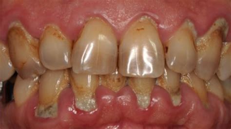 Advanced Periodontal Disease Before And After