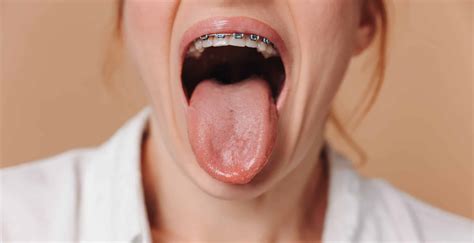 Why Does My Tongue Hurt After Dental Work? Common Causes