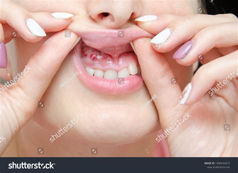 743 Gum Is Swollen Images, Stock Photos & Vectors | Shutterstock