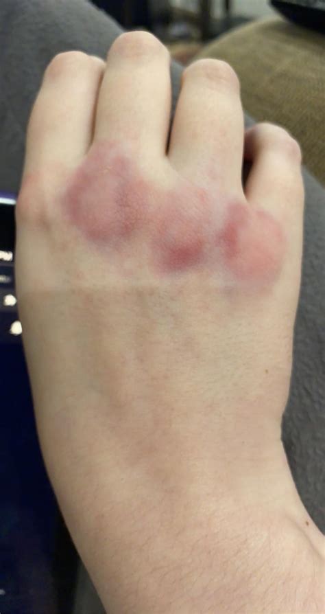 Why Are My Knuckles Red