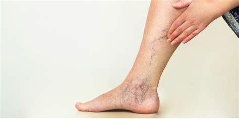 Spider Veins - San Luis Obispo, CA | Coastal Dermatology + Aesthetics
