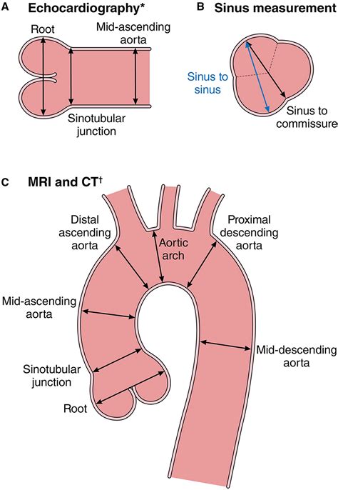 Aortic Root Dilatation