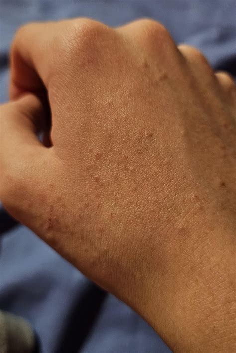 Small pinkish red spots on back of hand : r/SkincareAddicts