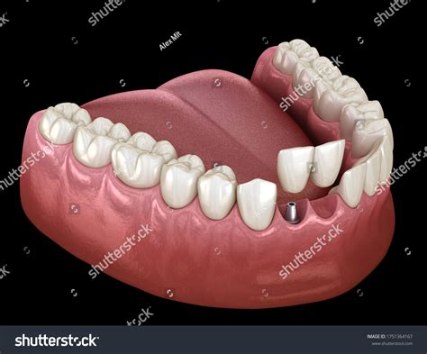 Cantilever Bridge Dental