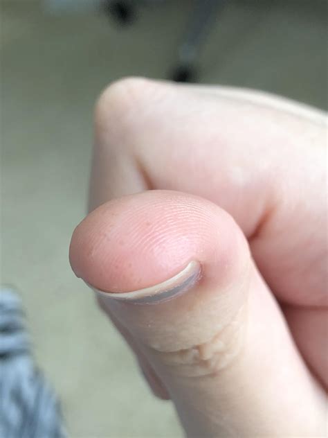 Why Is There A Lump On My Fingernail at James Jennings blog