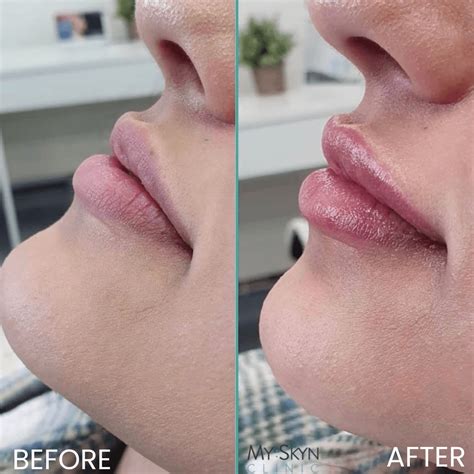 Lip Filler Before and After: MySkyn Clinic