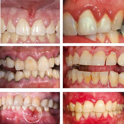 Understanding Holes in Gums: Causes, Symptoms, and Treatment Options for Optimal Oral Health