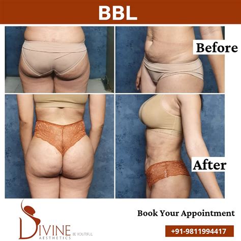 BBL-Before-After | The Brazilian buttock augmentation is a p… | Flickr