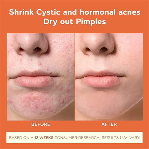 Skincare For Hormonal Chin Acne at Bruce Lohr blog