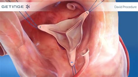 Cardioroot Woven Aortic Graft - Getinge