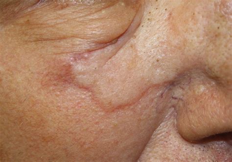 Basal Cell Carcinoma Early Stages Nose