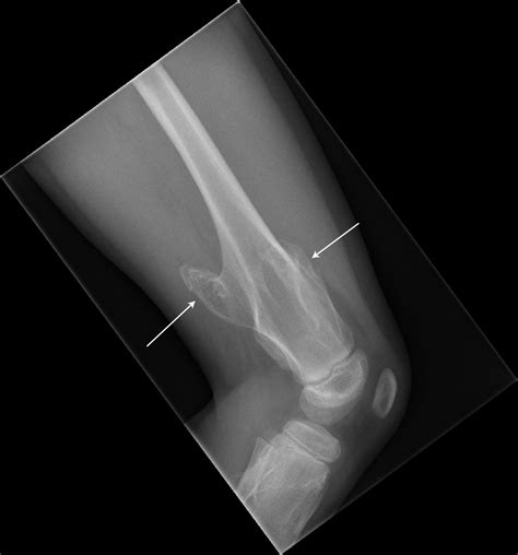 Lump On Arm Just Above Wrist at Jeremy Burris blog