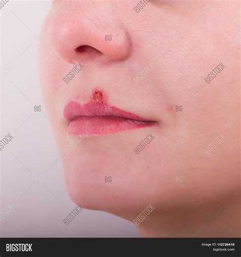 Girl lip diseased herpes. scabs on the stage of drying image & stock photo. 112726418