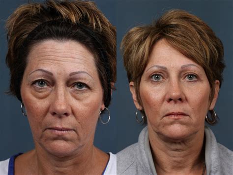 Eyelid Surgery Before and After Photo Gallery | Louisville & Lexington, KY | CaloAesthetics ...