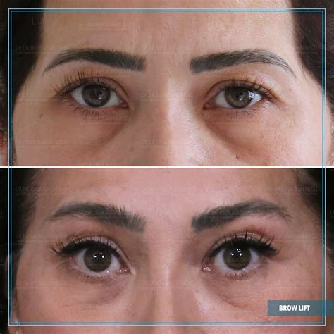 Endoscopic Medial Brow Lift - Ufuk Askeroğlu