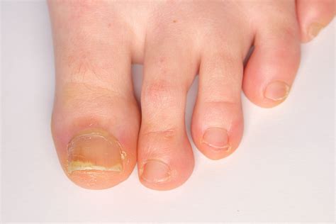 How To Get Rid Of Thickening Toe Nails