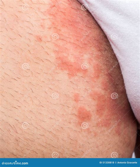 Ingle del eczema foto de archivo. Imagen de paciente - 51330818