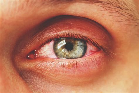 Differences Between Pink Eye and Allergies | LifeMD