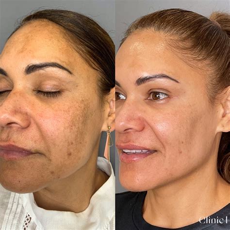 Melasma Treatment