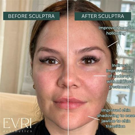 Sculptra vs. Traditional Fillers: Which is Right for You - Evri Aesthetics