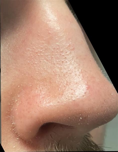 Difference in sebaceous filaments on nose week 1 and week 3 on 20 mg/day : r/Accutane