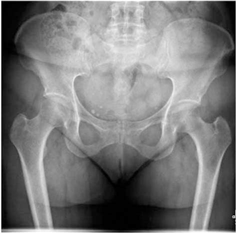 Insufficiency fractures of the sacrum | BMJ Case Reports