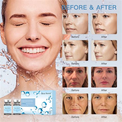 Skinbooster Meso Secret Injectable Hyaluronic Acid - Deenorathread