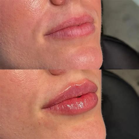 Lip Filler Before and After - Before After Journey
