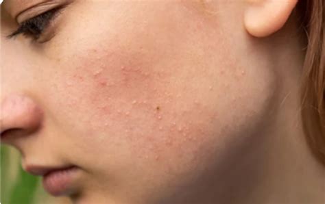 What is Fungal acne? - Types, Cause and Treatment - Cureskin