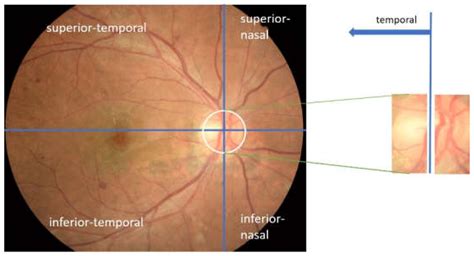 Efficient and Robust Method to Detect the Location of Macular Center Based on Optimal Temporal ...