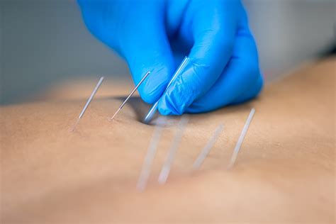 Dry Needling vs. Acupuncture | Key Differences