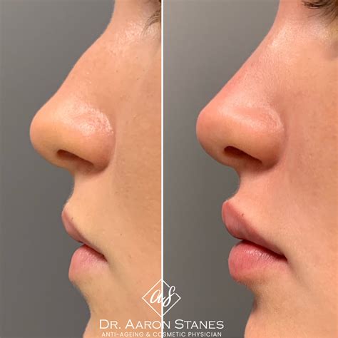 Non Surgical Nose Job Round Tip at Greg Booth blog