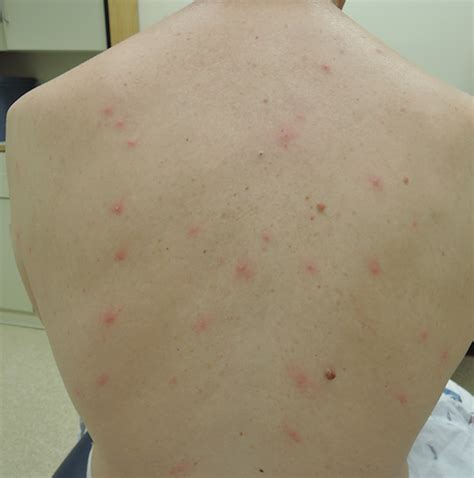 Larval Tick Infestation Causing an Eruption of Pruritic Papules and Pustules | MDedge