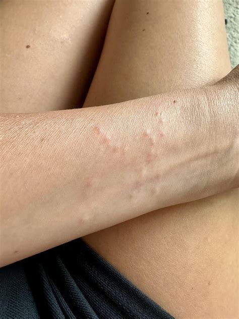 Little Red Bumps On Arm : r/DermatologyQuestions