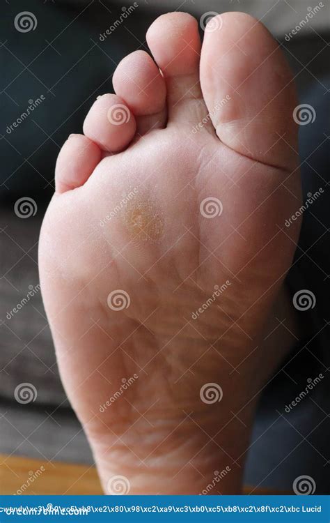 Callus On Bottom Of Foot