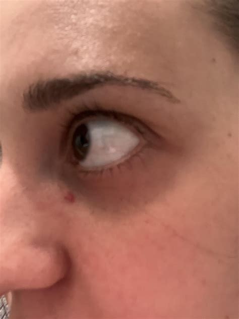 Sudden Red Dot on Face : r/SkincareAddicts