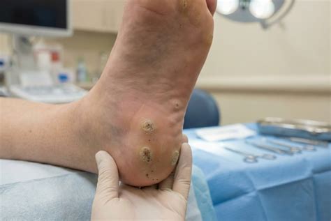 Warts vs. Corns: What’s the Difference? - Aventus Clinic