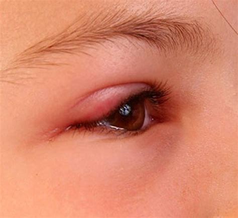 Swollen Eyelid - Symptoms, Treatment, Pictures, Causes | HealDove