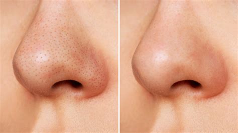 How to Remove Blackheads on the Nose Naturally