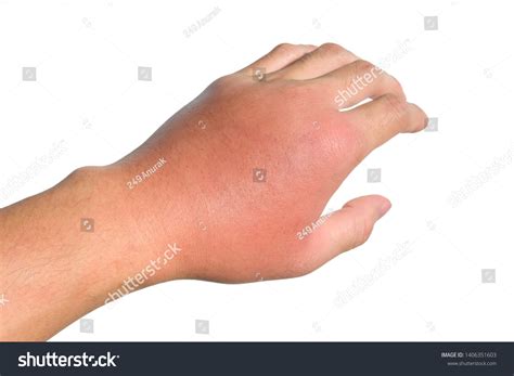 18,184 Cellulitis Images, Stock Photos & Vectors | Shutterstock