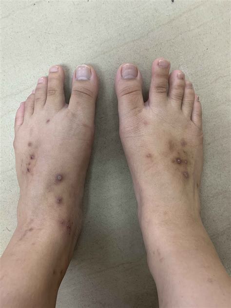 First Class Tips About How To Get Rid Of Mosquito Bite Scars ...