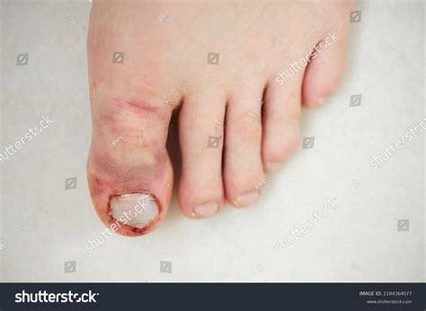 Fractured Toe Broken Big Toe Stock Photo 2184364077 | Shutterstock