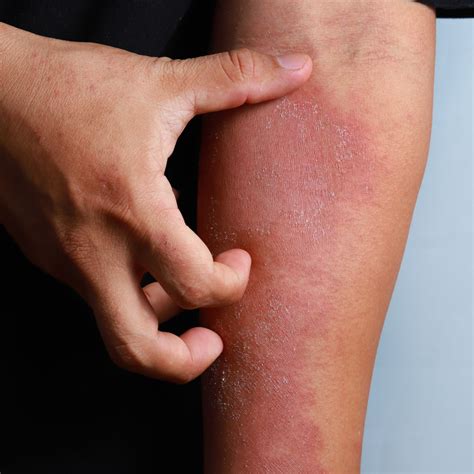 Dermatitis de contacto: causas, síntomas y tratamiento efectivo
