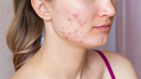 What Causes Pimples on Cheeks? – NutritionFact.in
