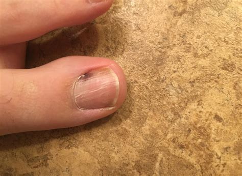 black spot under toenail melanoma pictures | Symptoms and pictures
