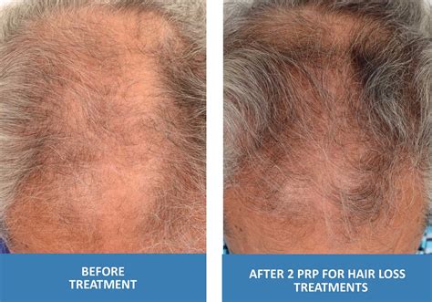 PRP For Hair Loss - Platelet Rich Plasma in Springfield Missouri