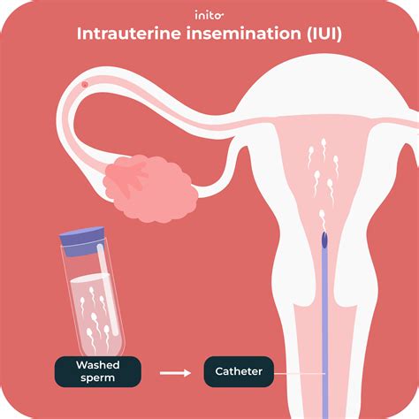 Artificial Insemination Women