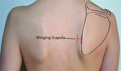 What is winged scapula and how to fix it - Training for Acro - T f A